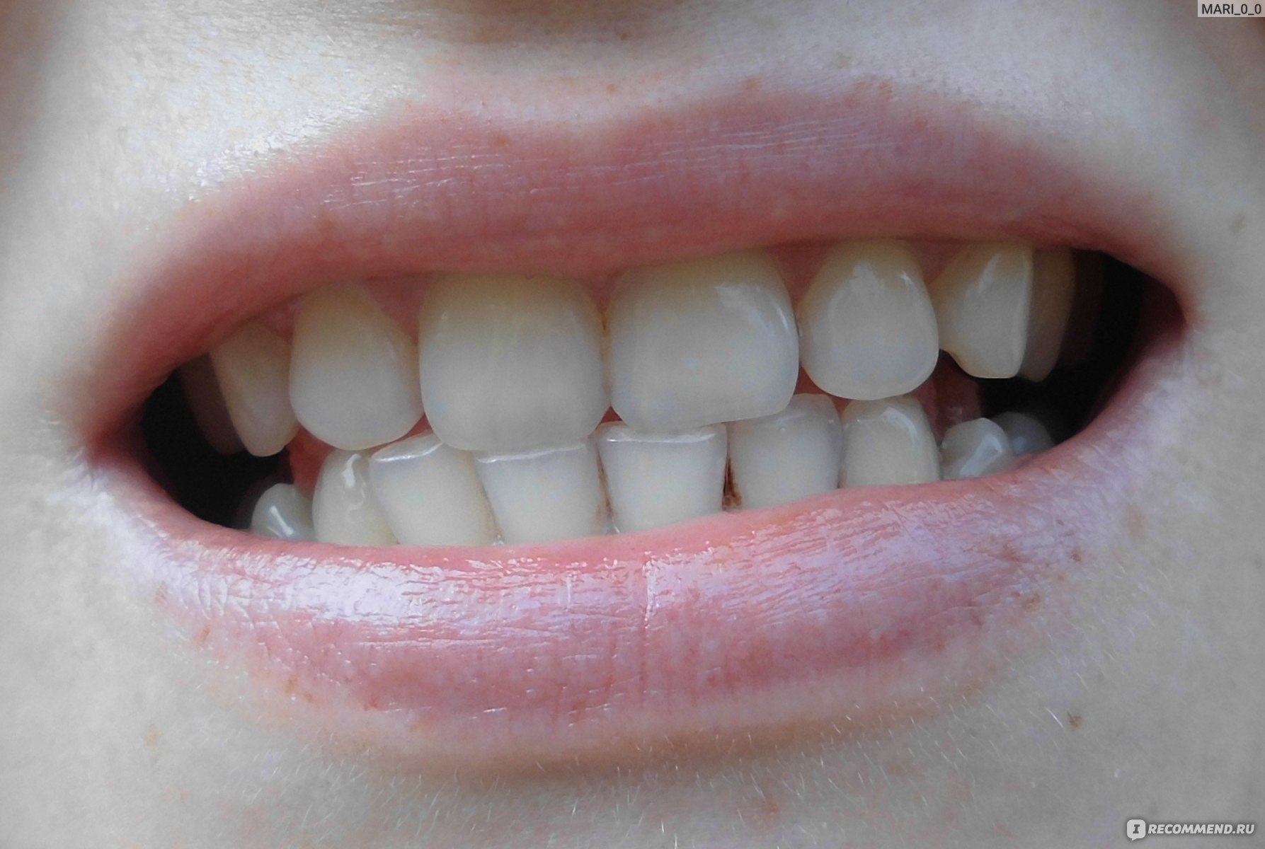 3 способа убить зубы отбеливанием – всё про «народные методы»