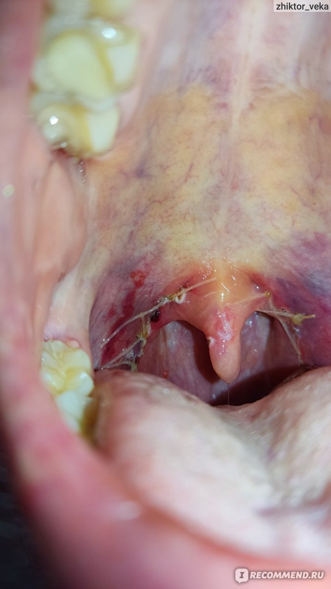 Тонзиллэктомия под наркозом - «Удаление нёбных миндалин (тонзиллэктомия)» |  отзывы