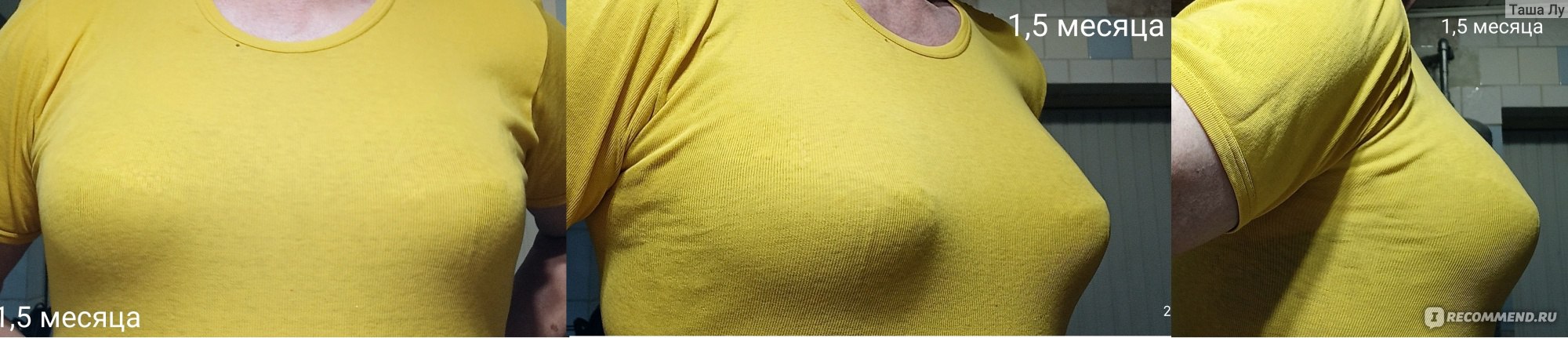Липофилинг груди фото