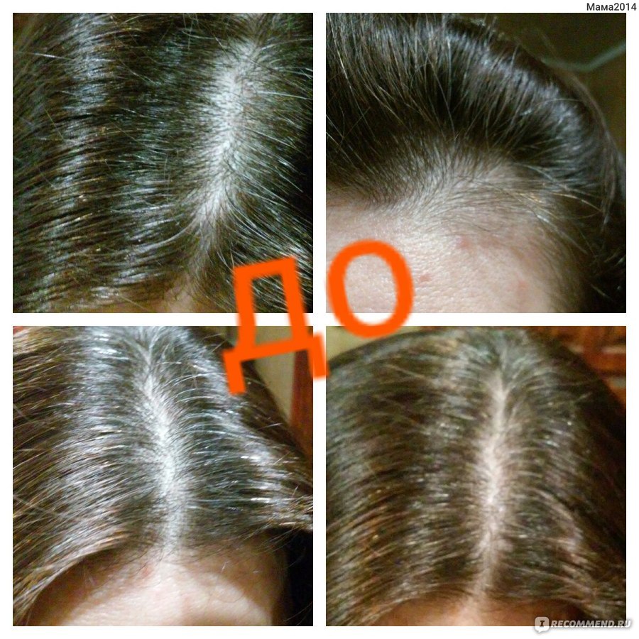 Помогает ли дарсонваль от выпадения волос для женщин