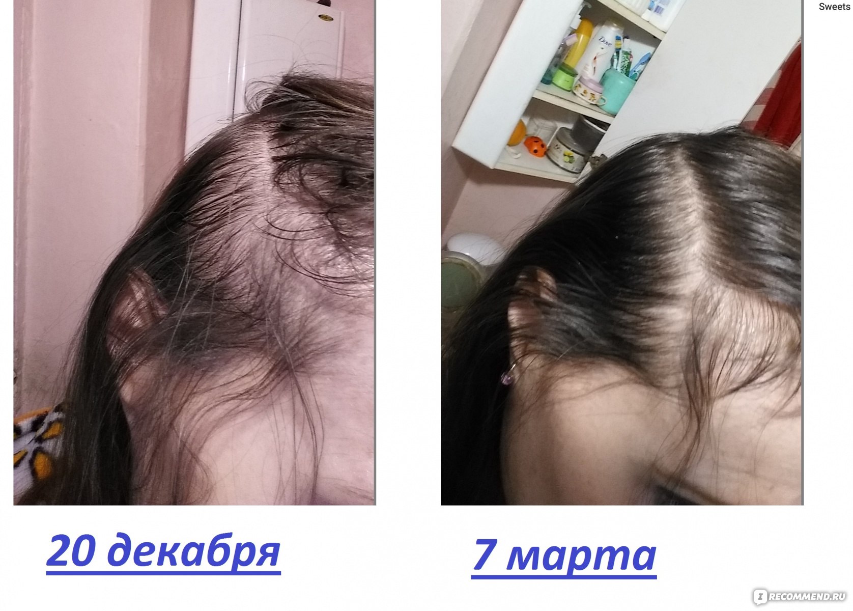 Дарсонваль для волос до и после