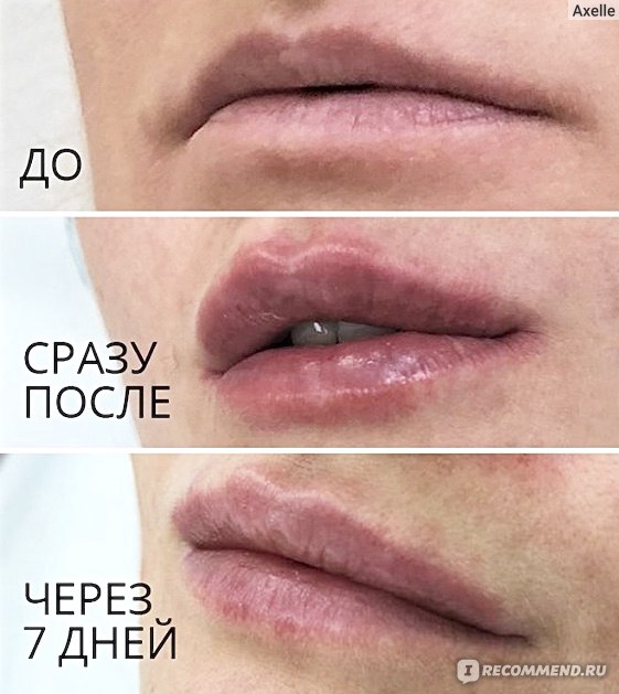 Увеличение губ ✔️ причины появления отеков ⭐️ Filler-Shop