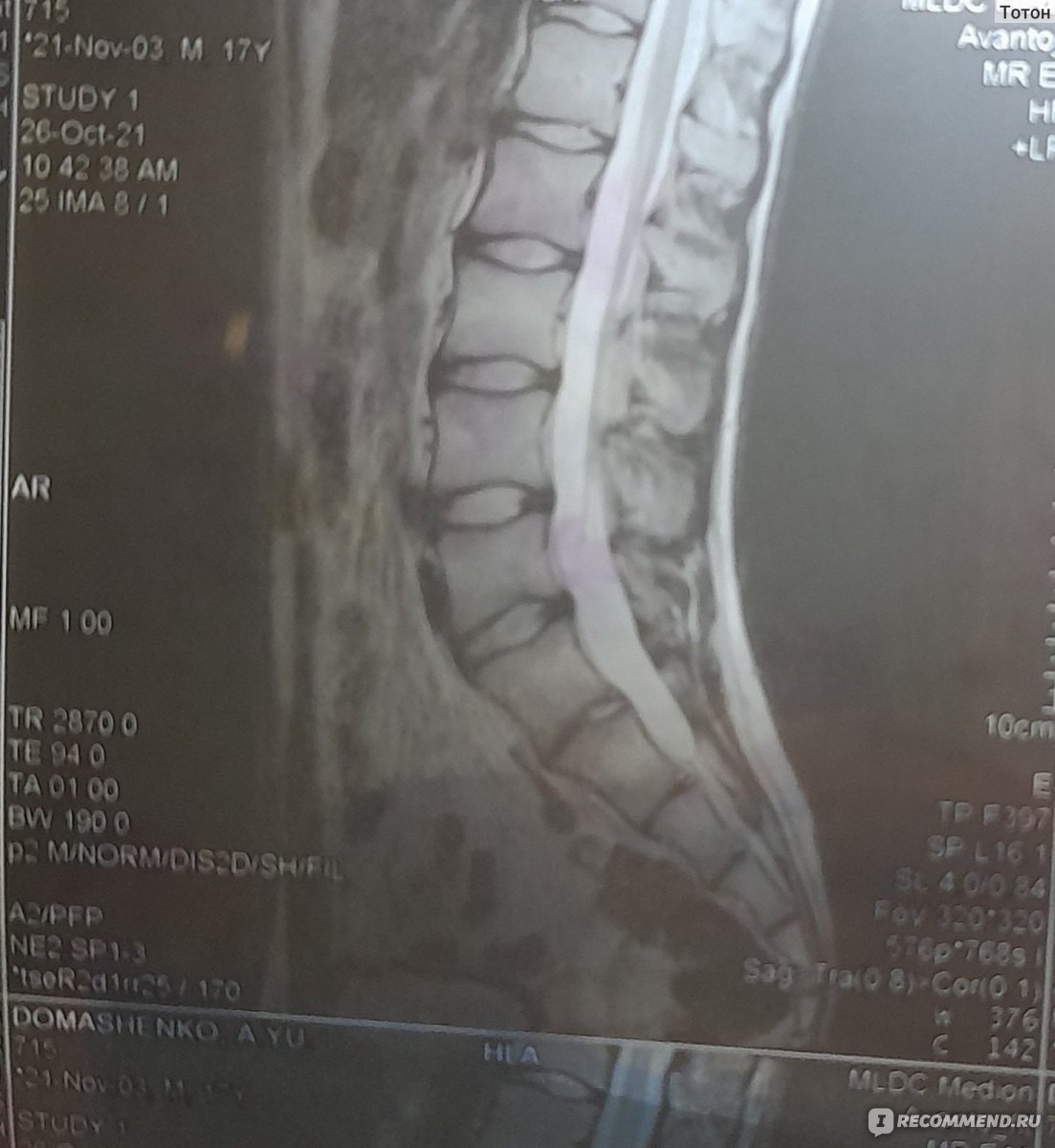 МРТ позвоночника - «Зачем нужна МРТ, если не болит ни спина, ни шея? Боли  ещё нет, а на снимках проблемы уже ясно видны!» | отзывы