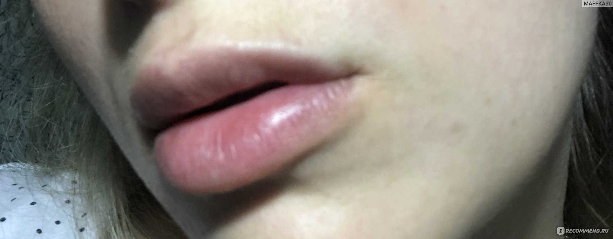 Виды филлеров для губ