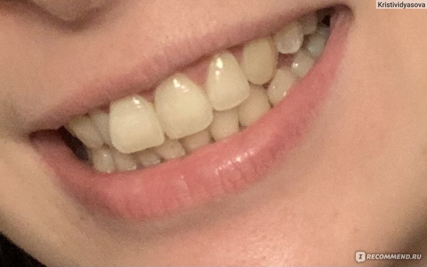 on white отбеливание зубов