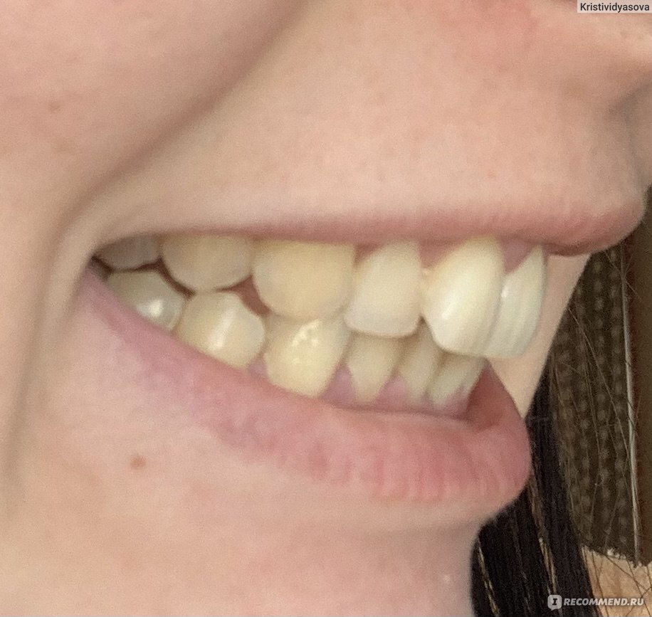 Отбеливание зубов малышева сменные насадки для зубной щетки oral b