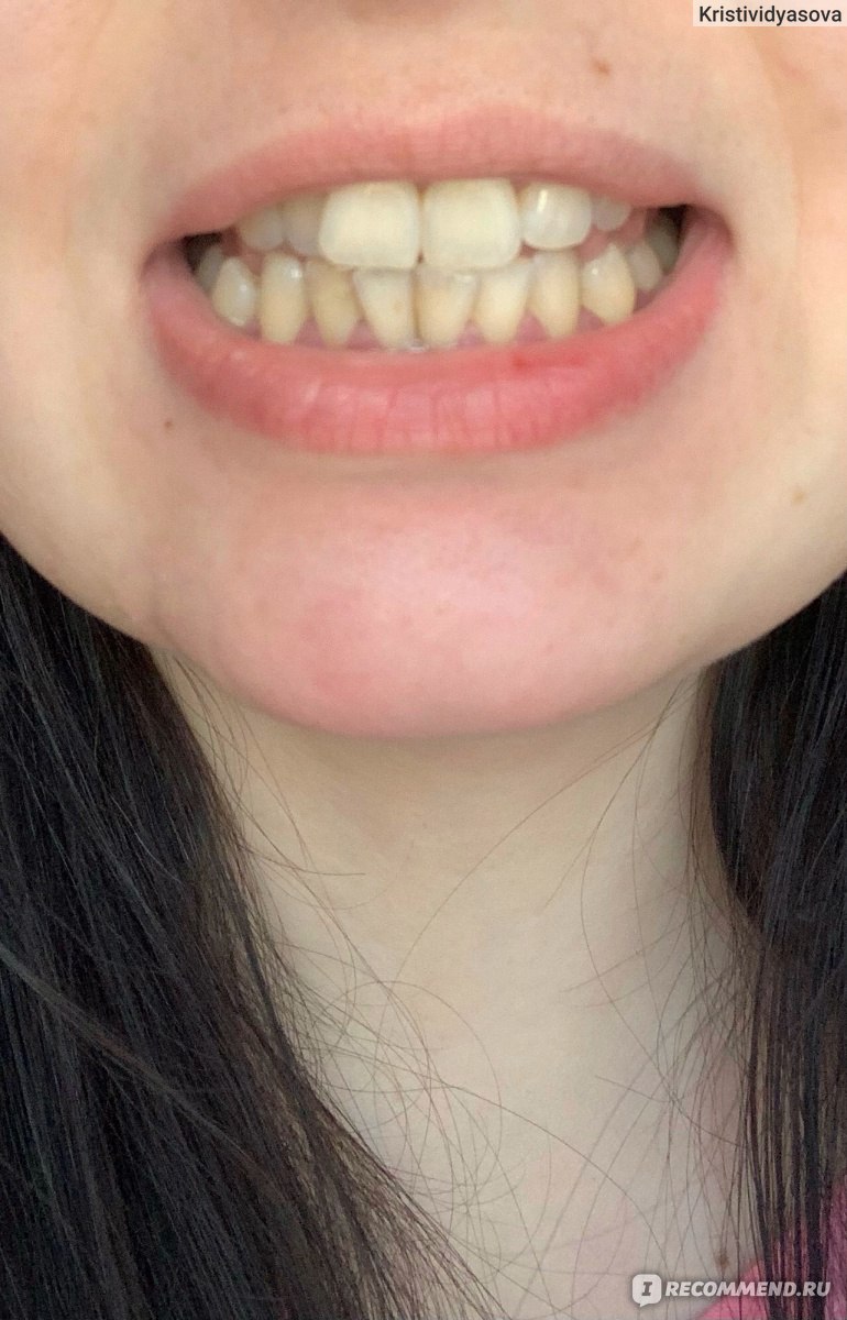 отбеливание зубов видео до и после