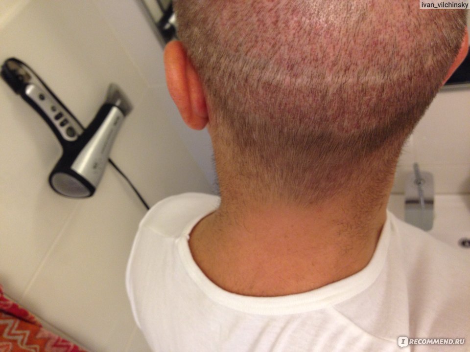 Бесшовная пересадка волос HFE фото