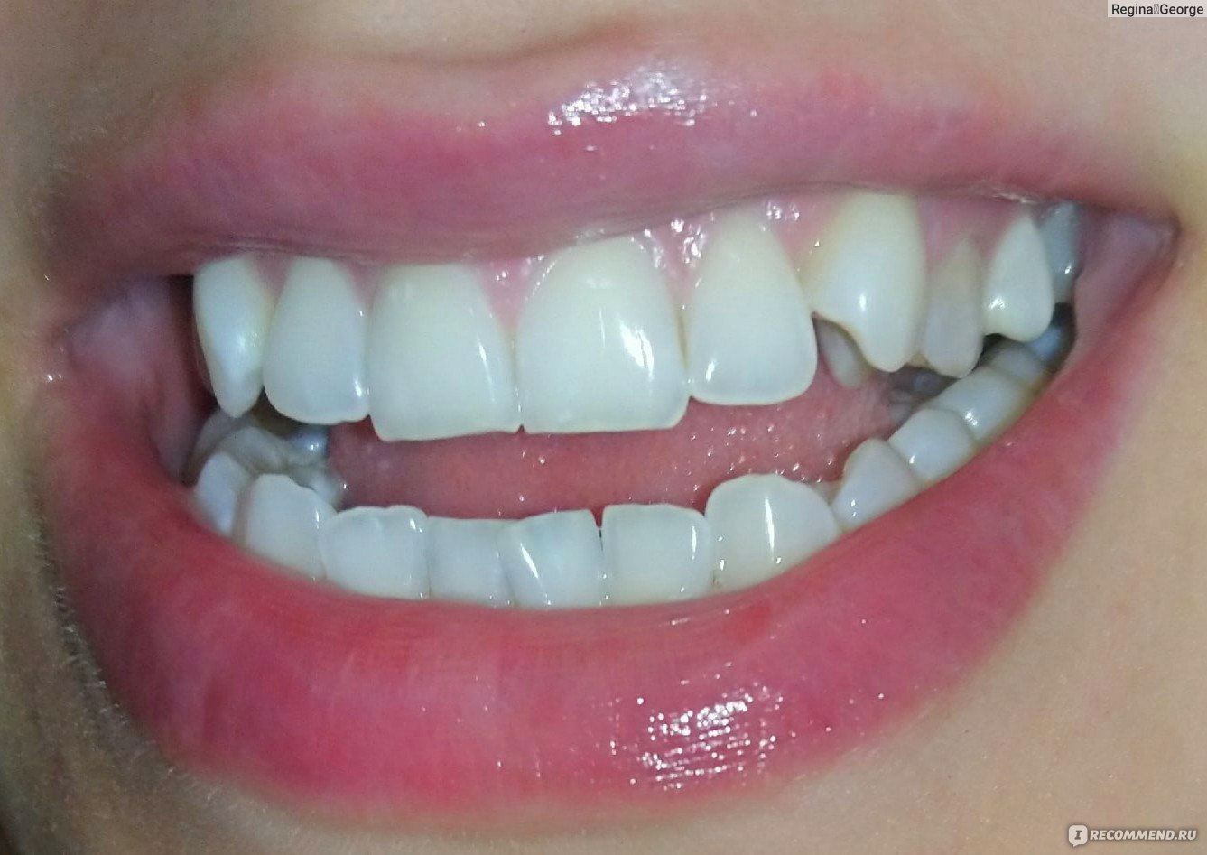 Полоски для зубов между зубами