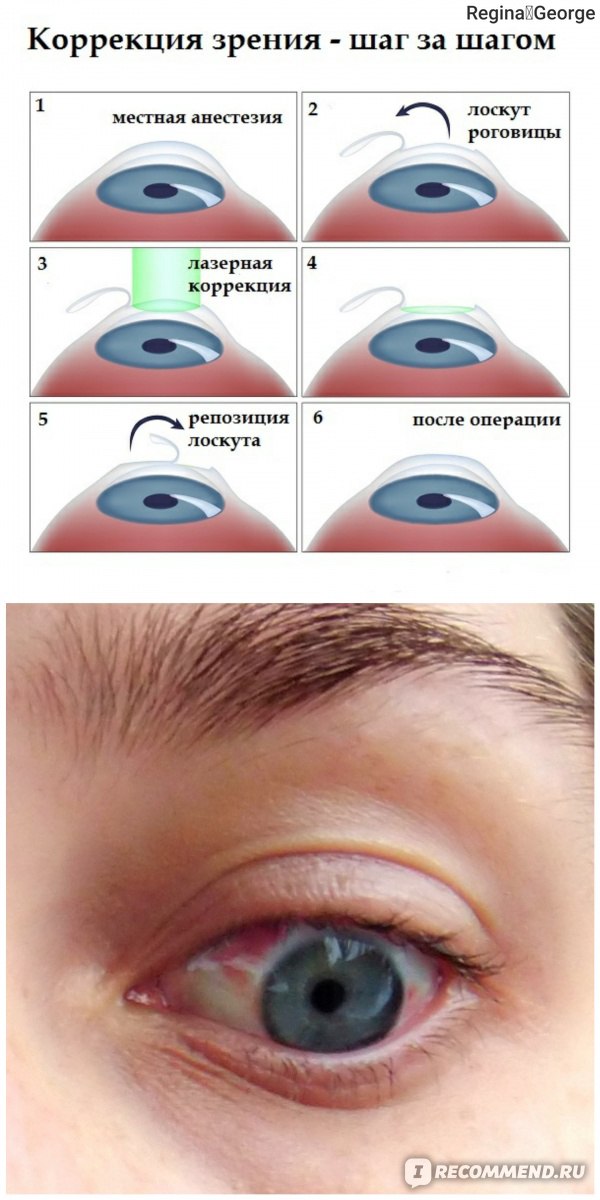 Зрение после лазерной коррекции: как помочь глазам привыкнуть к новому
