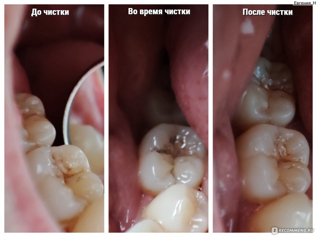 Ультразвуковой скалер Hailicare для удаления зубного налета из полости рта  - «Ультразвуковой скалер Hailicare для удаления зубного налета - лучшее  приобретение за последний год. В отзыве расскажу, почему прибор для  домашнего использования