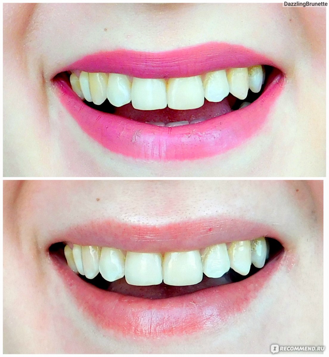 зубы до и после отбеливания полосками