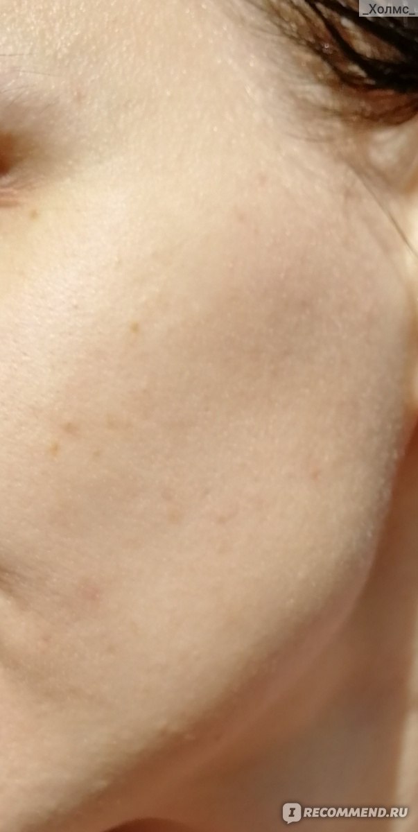 Как избавиться от тонкой кожи и синяков под глазами методами косметологии?
