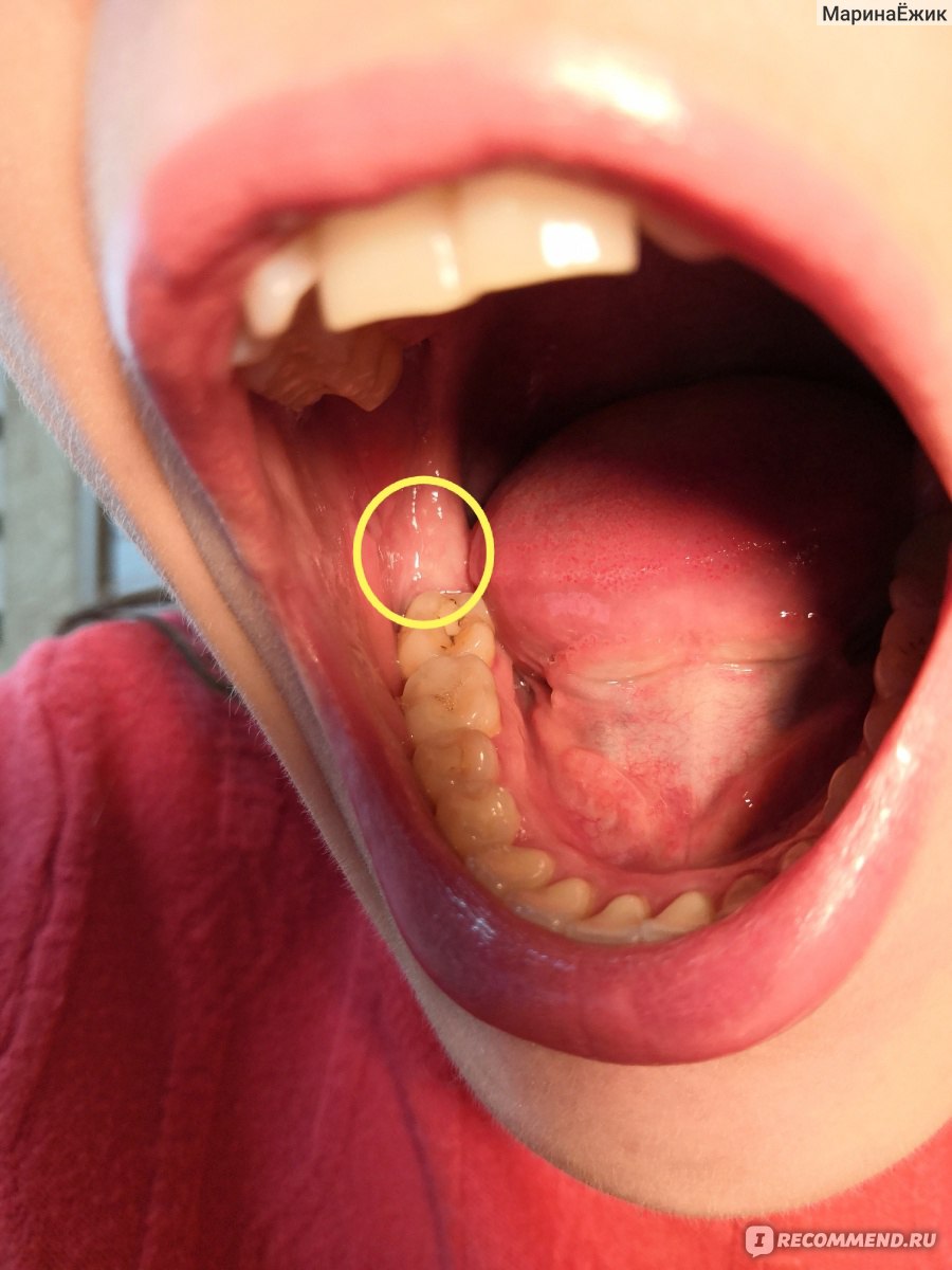 Боль после удаления зуба | Стоматология Митино