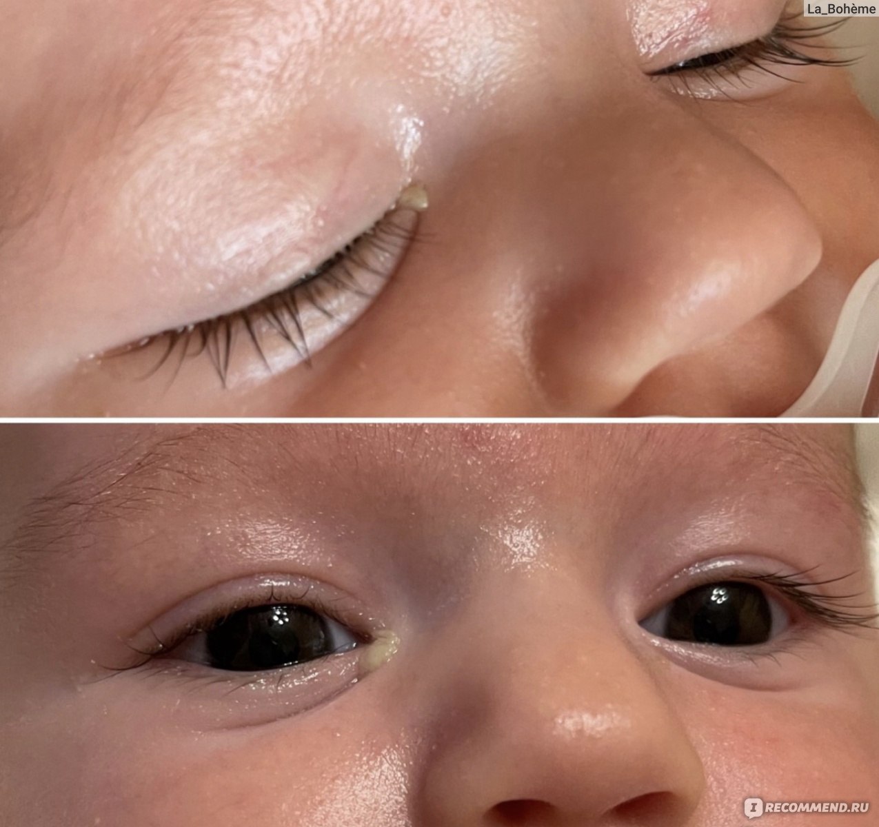 Дакриоцистит капли. Дакриоцистит новорожденных. Обработка глаз новорожденного. Массаж при дакриоцистите новорожденных. Дакриоцистит врожденный водянка слезного канала.
