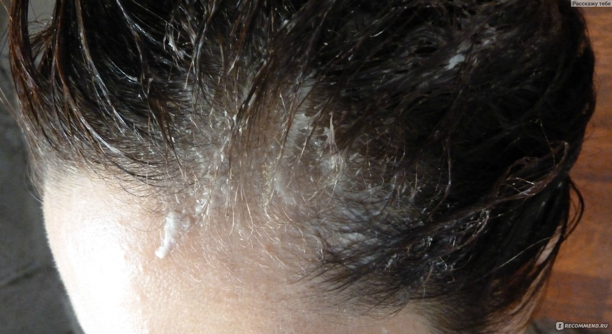 Выпадают волосы после себозола