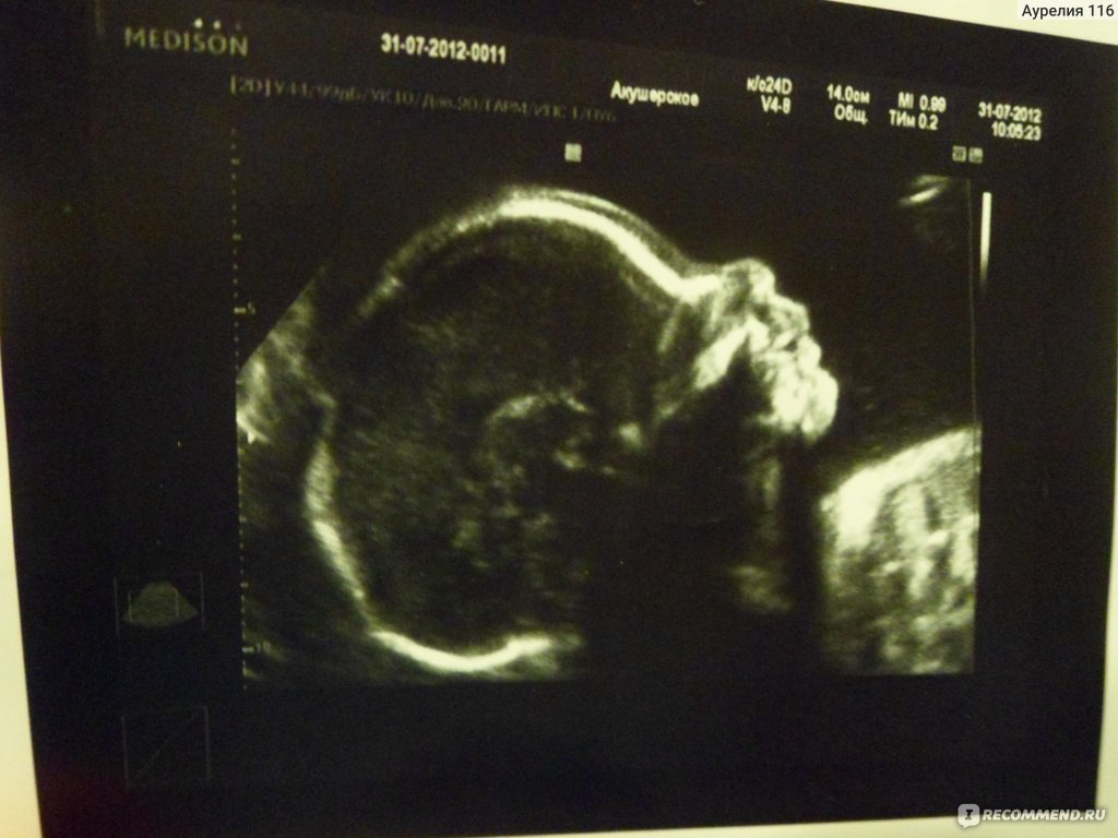 Фото узи в 30 недель беременности мальчика