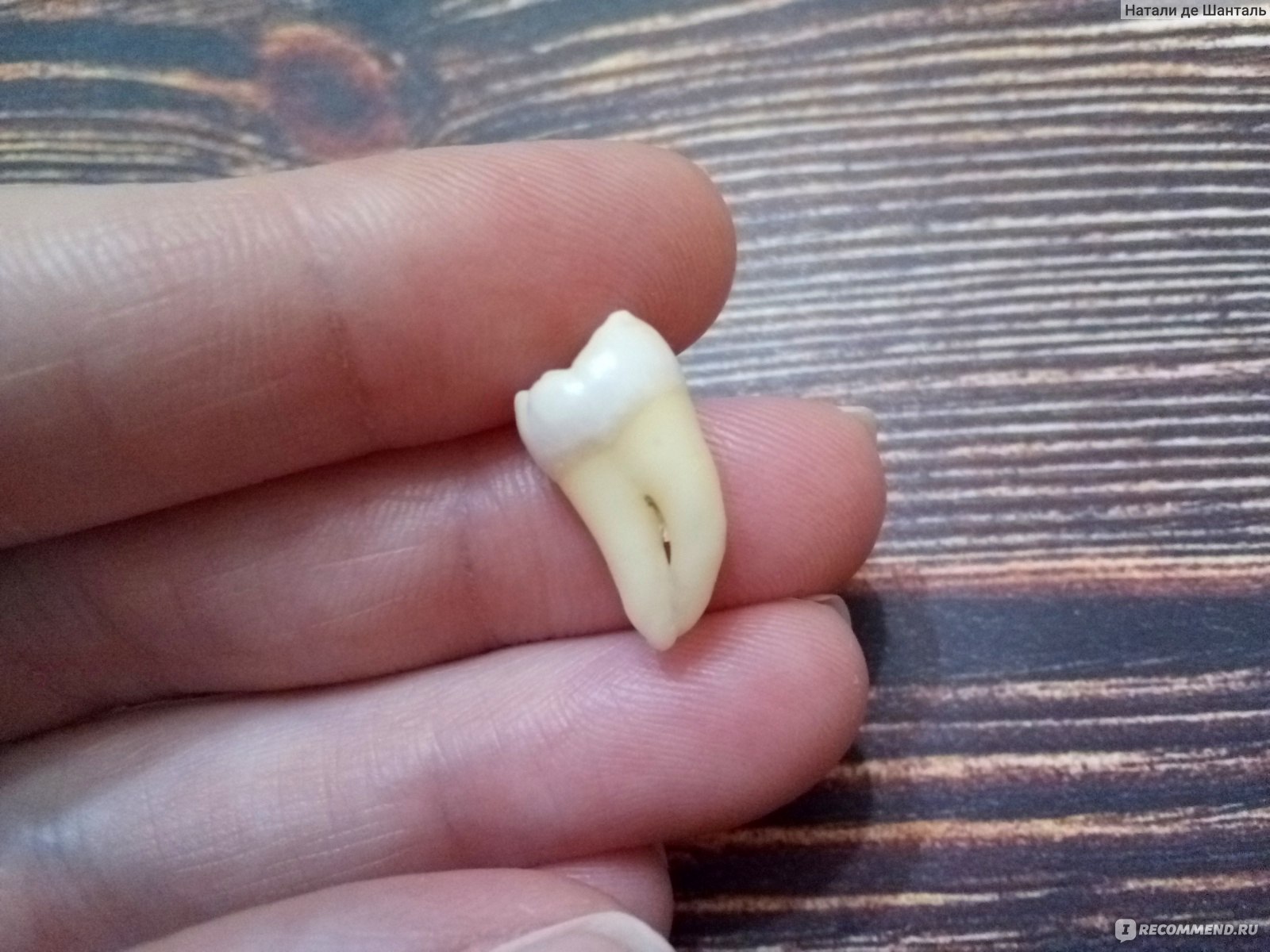 Как выглядит удаленный зуб
