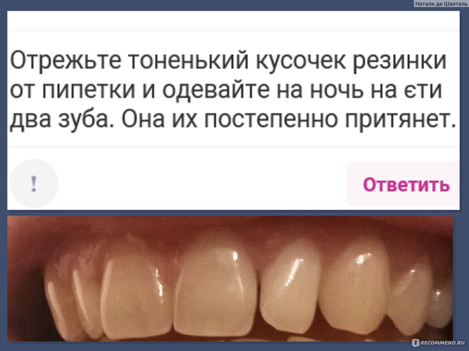 Уход за зубами в домашних условиях - «ОБНОВЛЕНИЕ 2022г ⚠️ Можно ли  соеденить диастему (