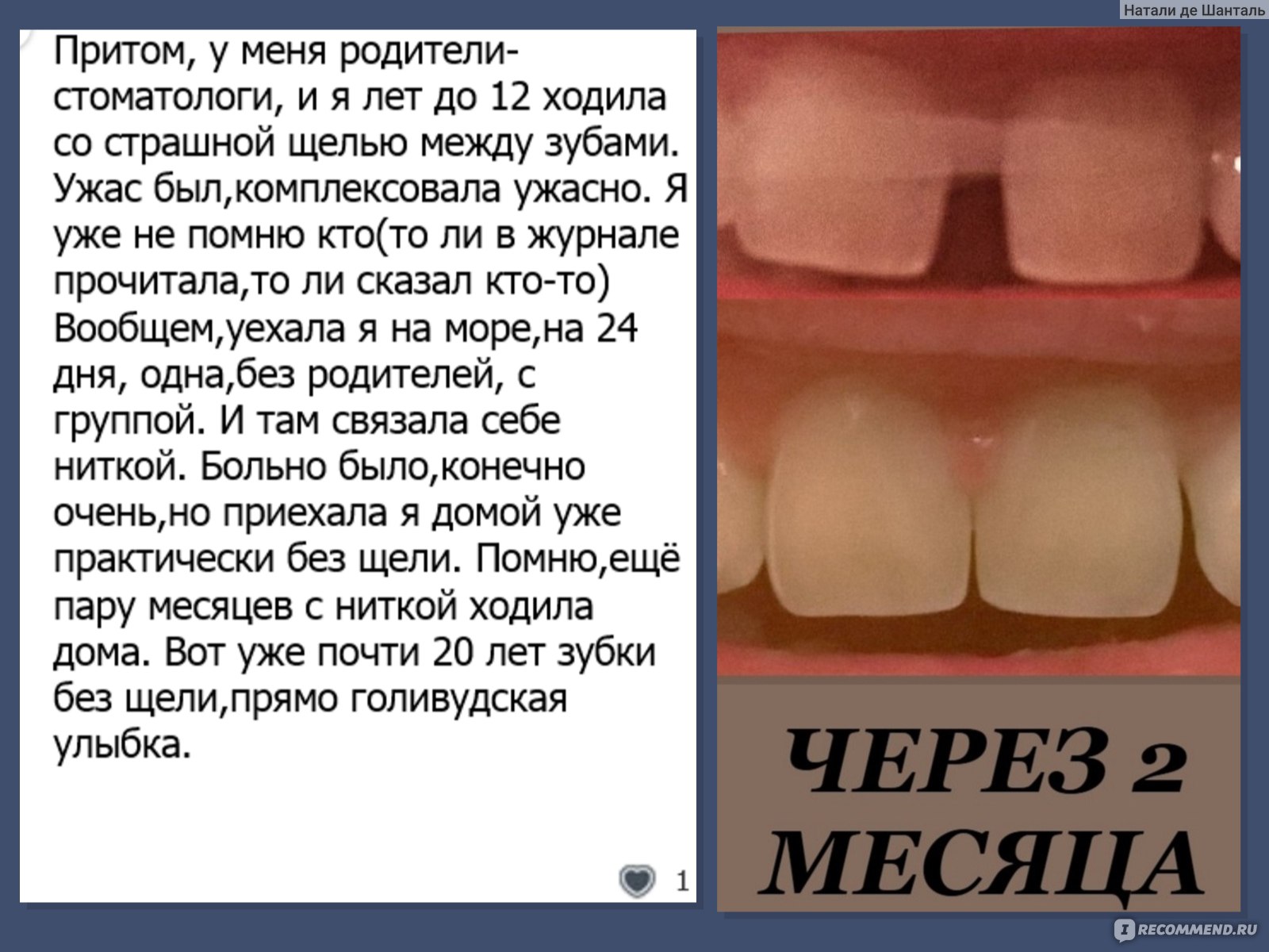 Бруксизм зубов