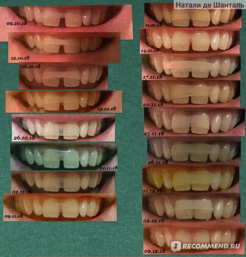 Пластинки для выравнивания зубов