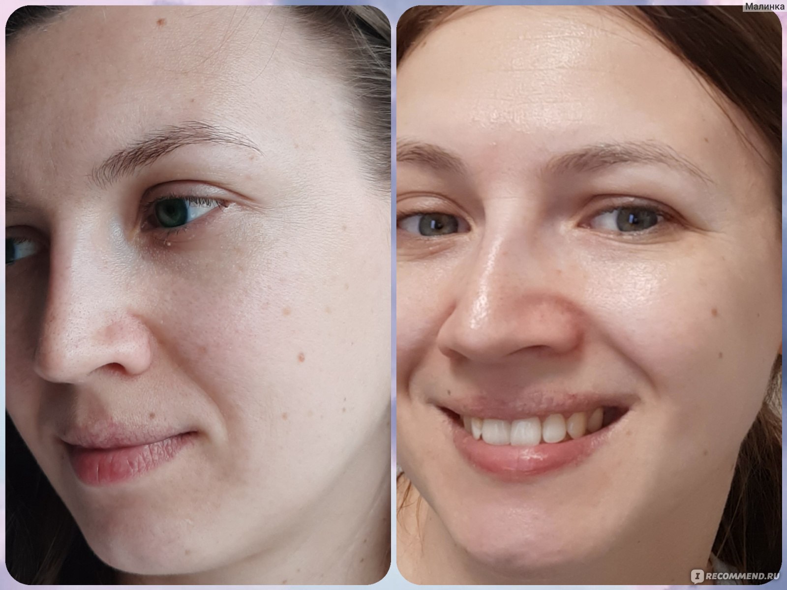 Уколы коллагена до и после. Коллаген лицо до и после. Эффект от коллагена для кожи.