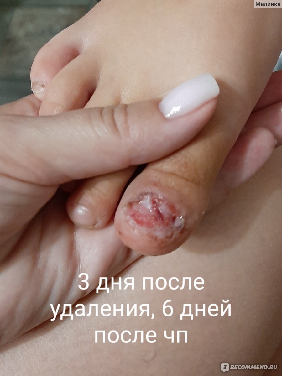 Травма и деформация ногтя