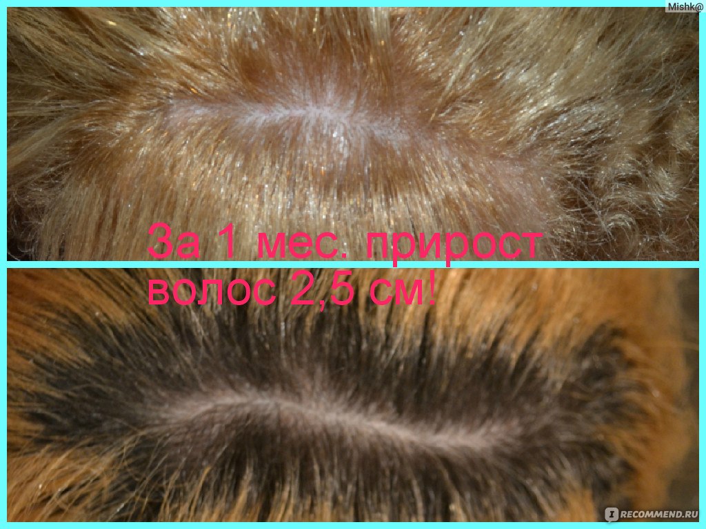 Пилинг кожи головы фото до и после