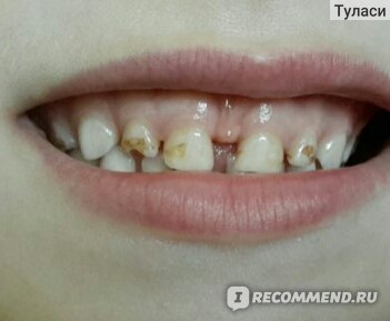 Гиперестезия зубов: как вылечить и как предотвратить?