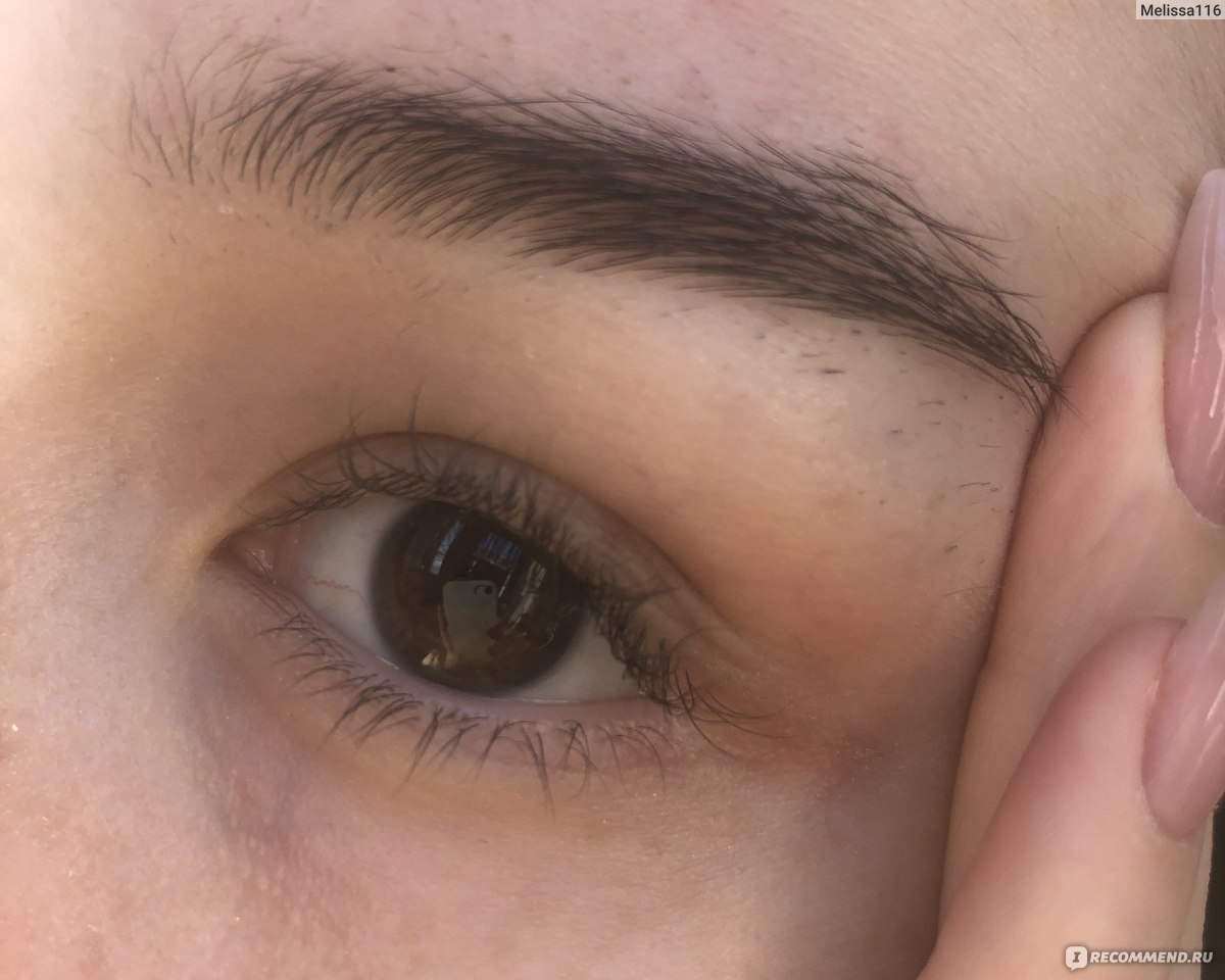 ресница под кожей. блефарит (воспаление края век). ресница под кожей. ресница под кожей. ресничный клещ demodex folliculorum.