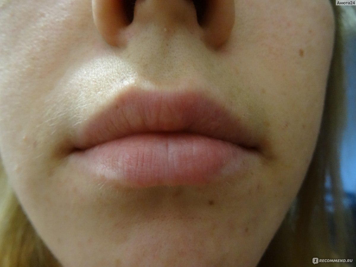 Увеличение губ, Можно ли сделать увеличение губ и коррекцию подбородка за одну процедуру?
