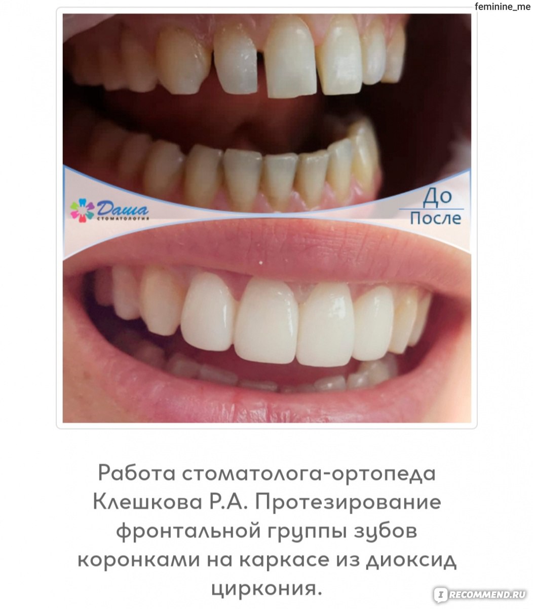 Цвет зубов – определение по шкале вита, причины изменения, восстановление.