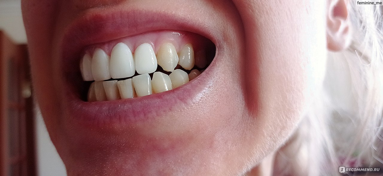 Цвет зубов — от серого до белого