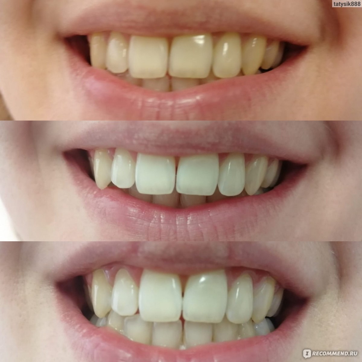 Brilliant smile косметическое отбеливание зубов - «Результат после второй  процедуры» | отзывы