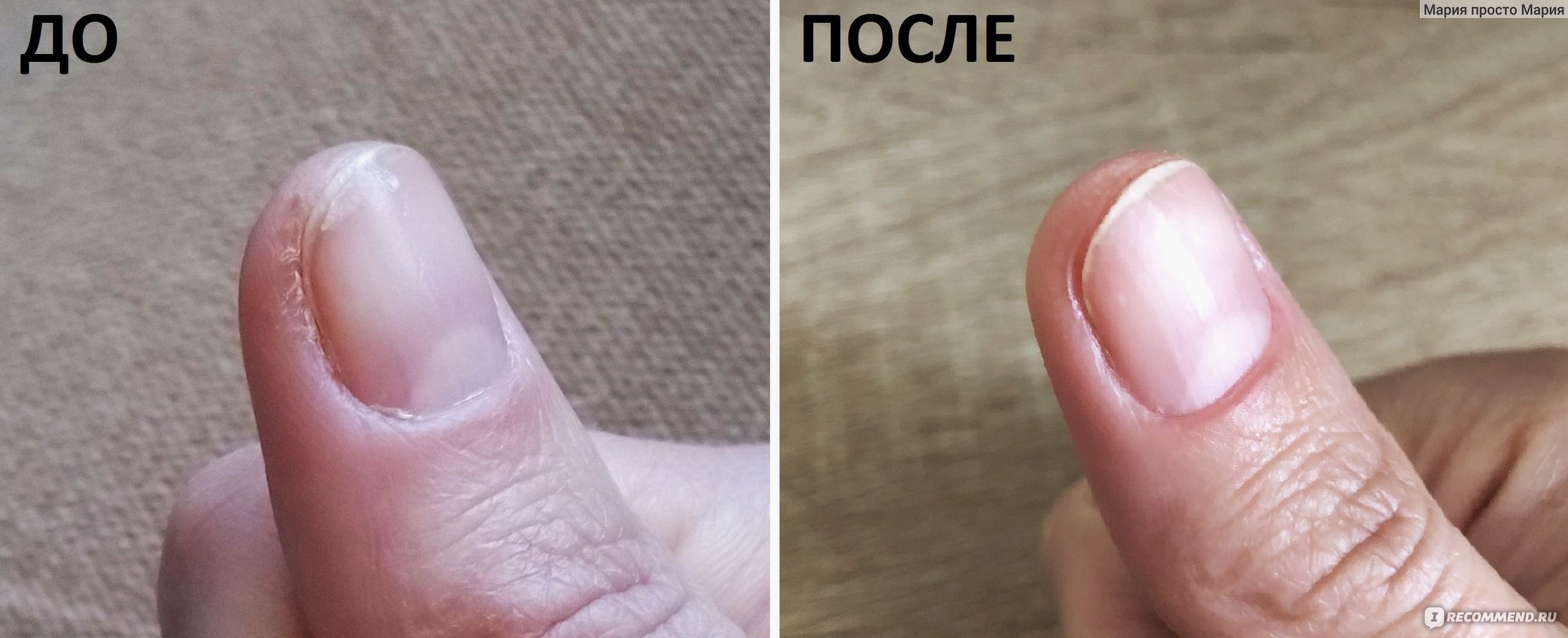 Боковые трещины ногтя на руке