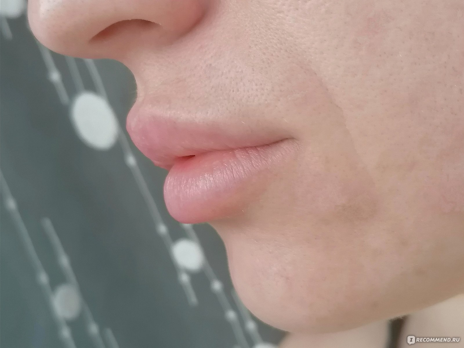 Увеличение / Аугментация губ с помощью препарата гиалуроновой кислоты фото