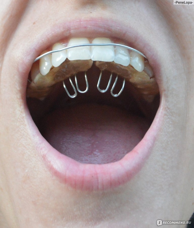 Съемная ортодонтическая пластинка - рекомендации по использованию