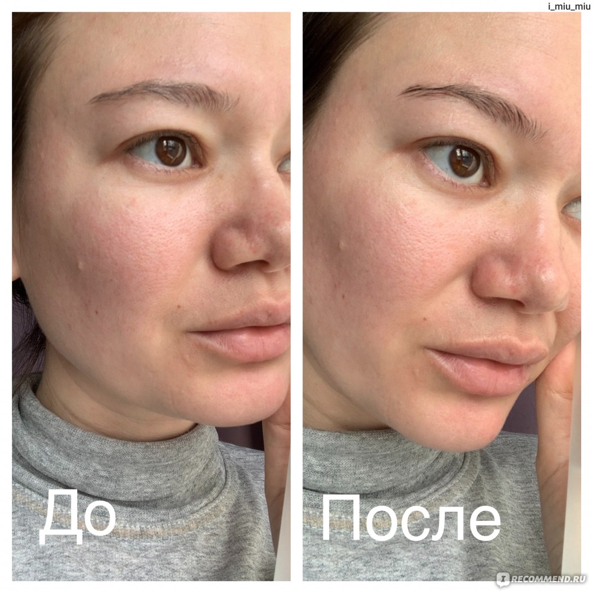 Восстановление упругости кожи skinlift ru. Сыворотка под макияж. Восстанавливает эластичность кожи. До и после использования косметики с пептидами. Тонус лица.