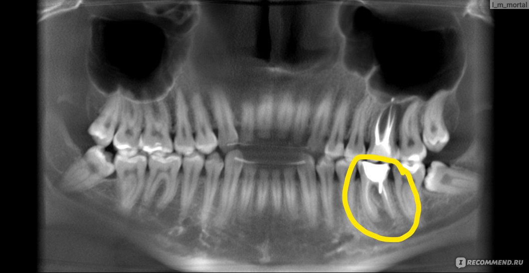 Алгоритм внутриротового лучевого исследования и описания снимков зубов