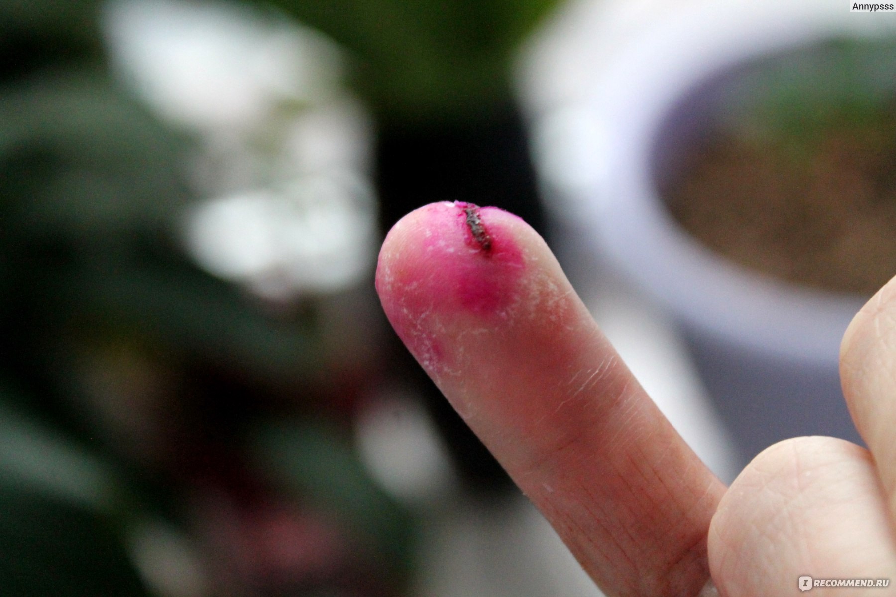 Почему нарывает палец возле ногтя, диагностика недуга