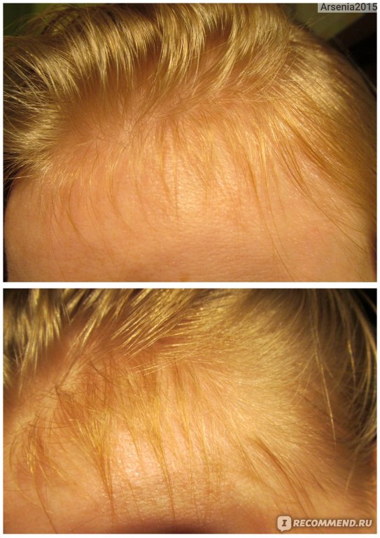 Восстанавливаются ли волосы после выпадения после родов