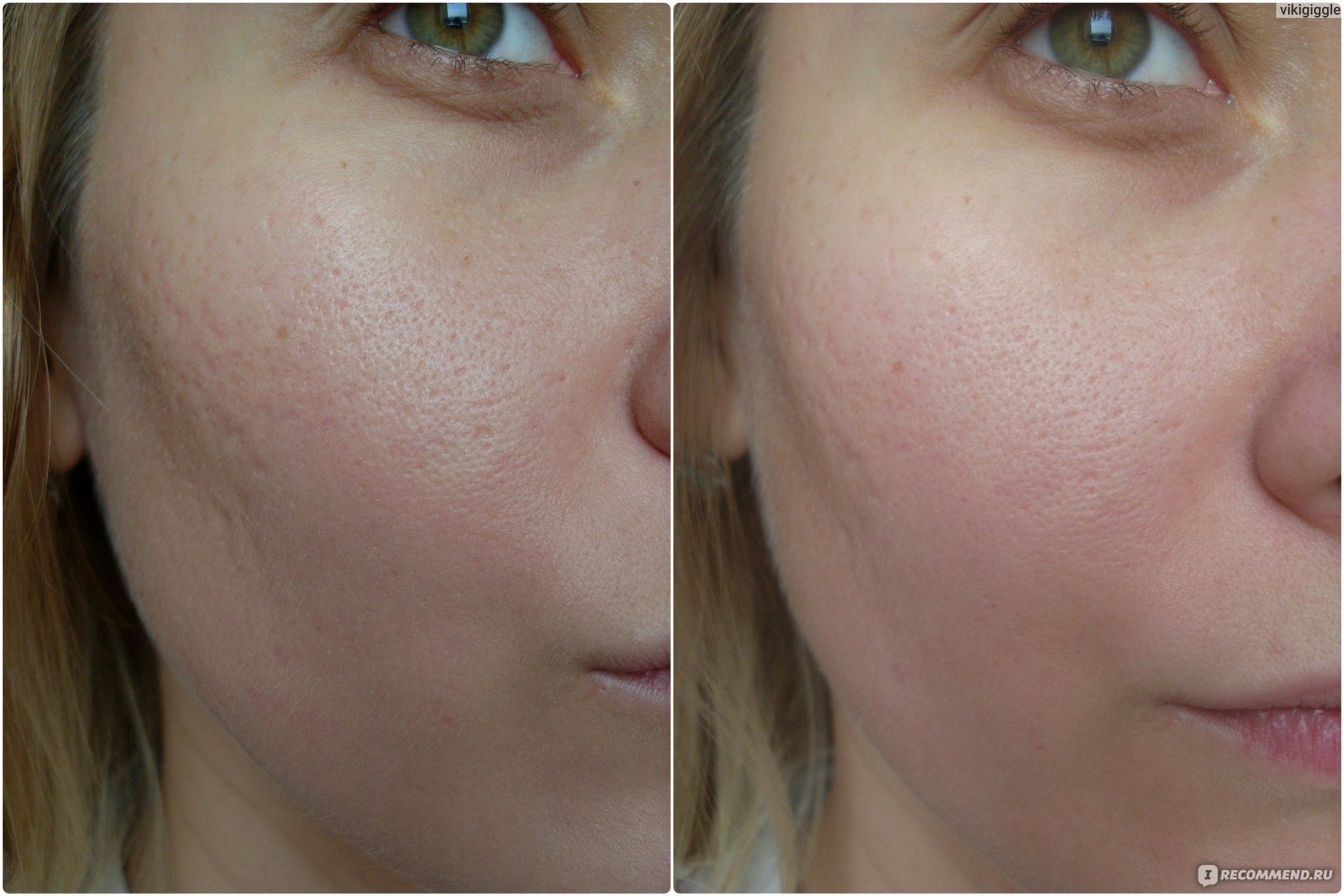 Праймер использование. Праймер для лица. Лицо с расширенными порами. База под макияж до и после. Праймер для шрамов на лице.