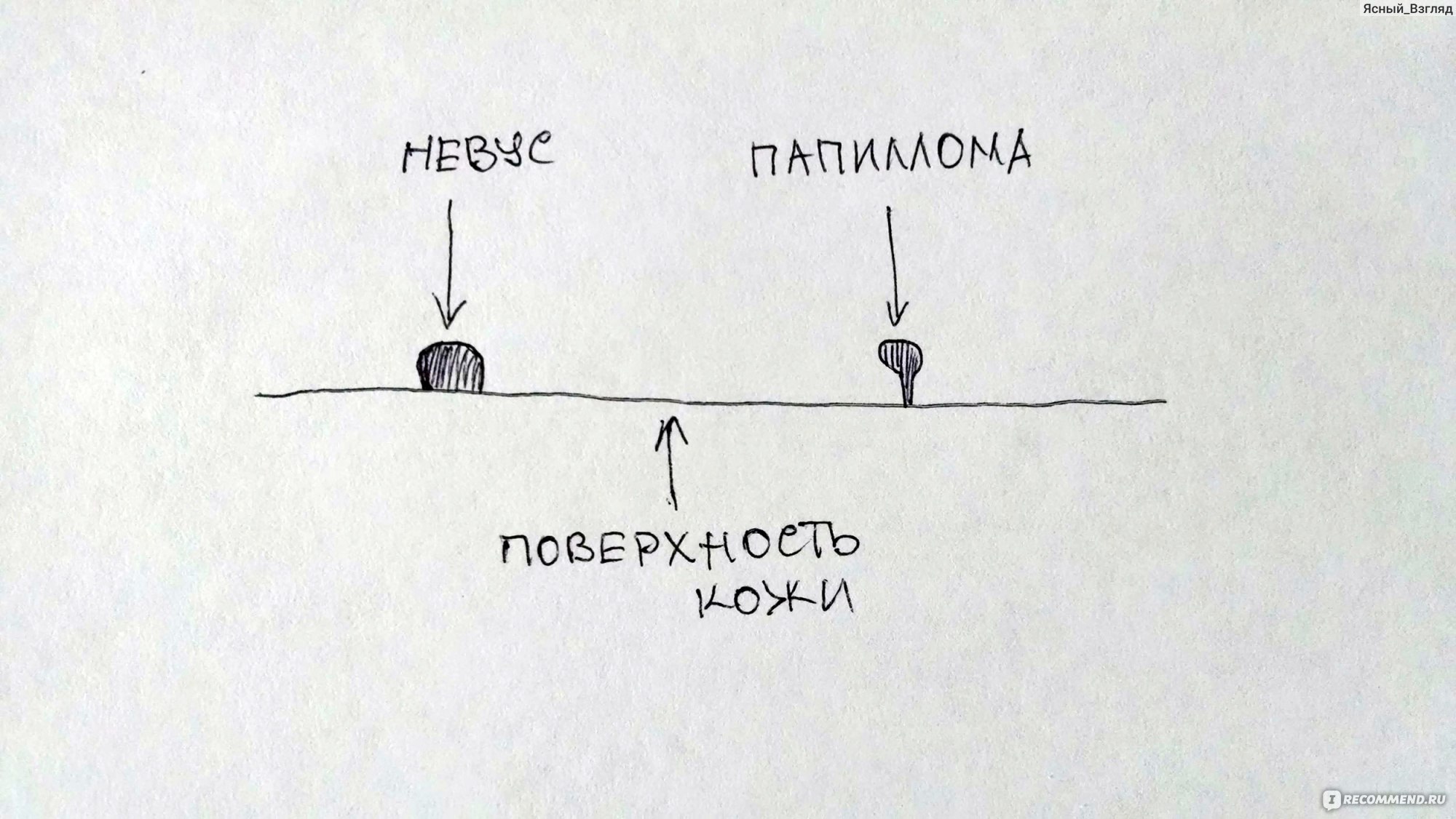 Различие между родинками, папилломами и бородавками - Клиника Созвездие Здоровья и Красоты