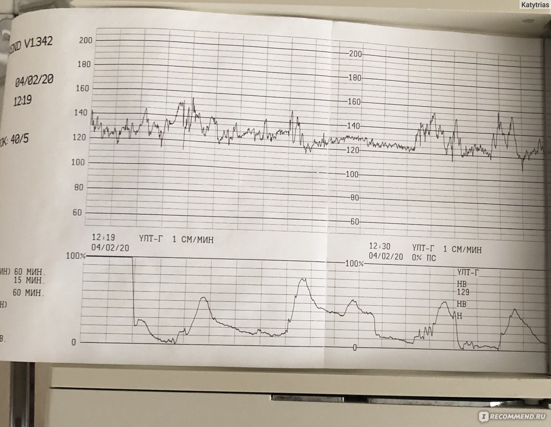 Схватки на ктг. КТГ при родовой деятельности. КТГ при схватках показатели. Как на КТГ показывает схватки.