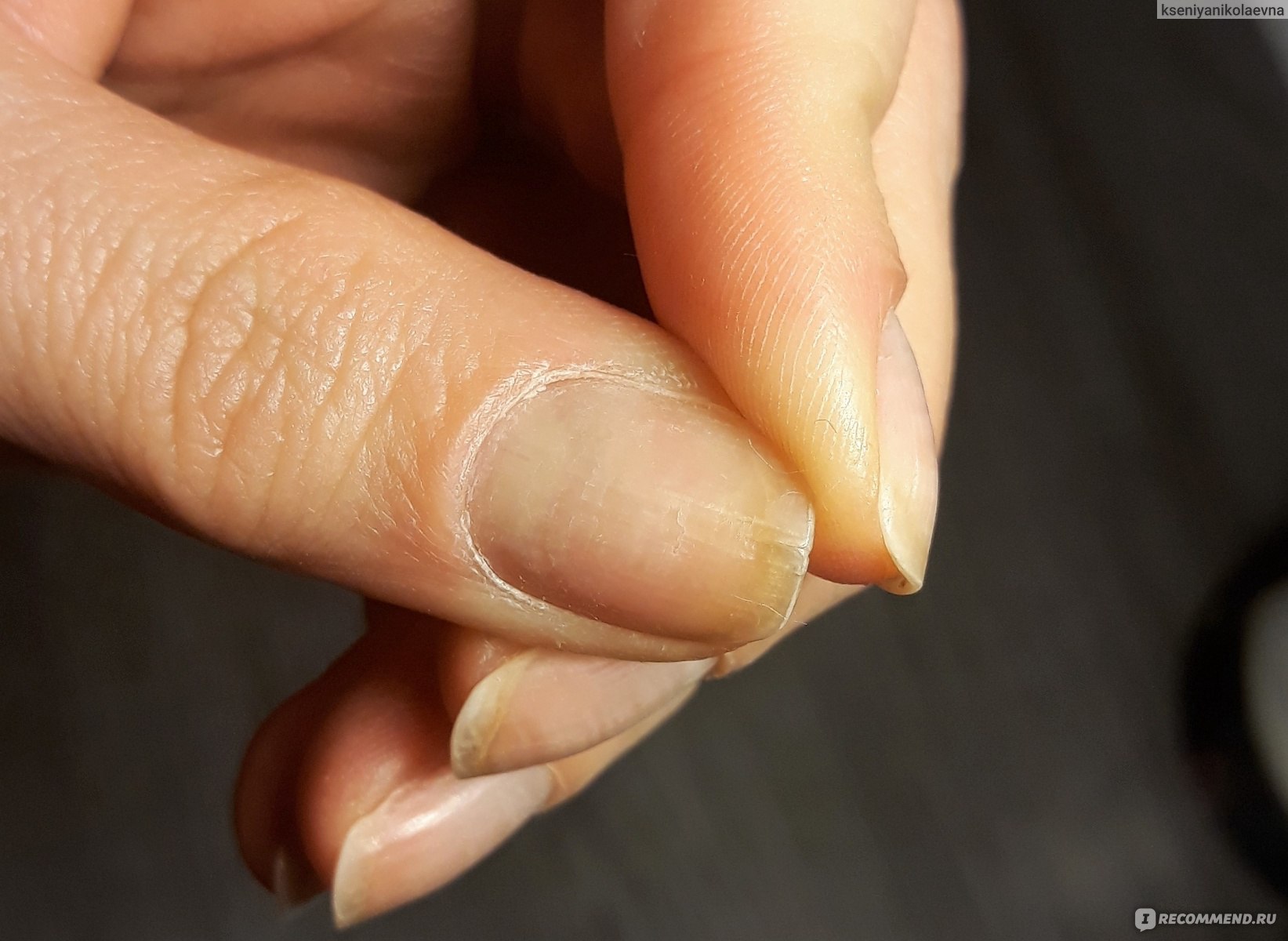 Маникюр трещины. Ногти отслаиваются от кожи на руках.