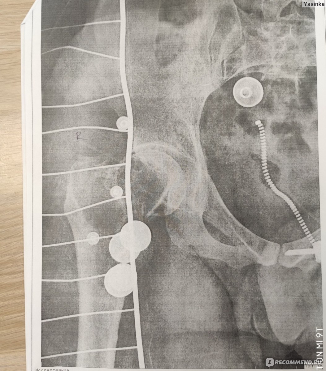 Эндопротезирование тазобедренного сустава - «Много боли, «брак» в  эндопротезировании. Пол года в больницах с открытой раной. Что нас спасло в  итоге.» | отзывы