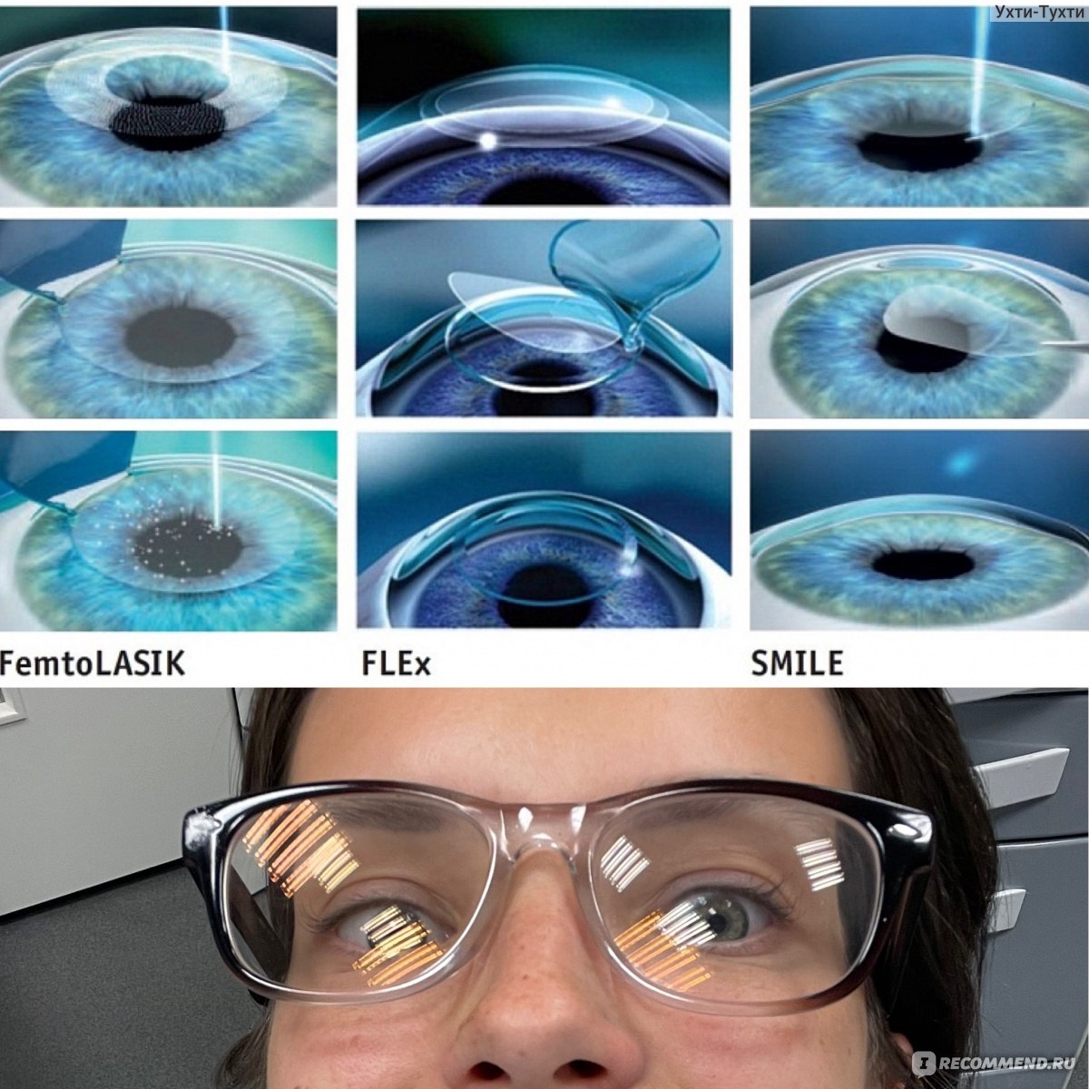 Лазерная коррекция зрения спустя много лет отзывы. Лазерная коррекция зрения ФРК. ФРК ласик Смайл. Лазерная коррекция RELEX smile. Коррекция зрения методом ласик.