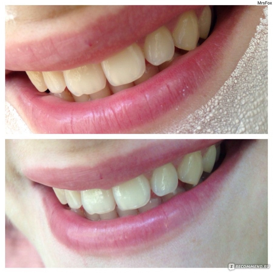 отбеливание зубов активированным углем до и после