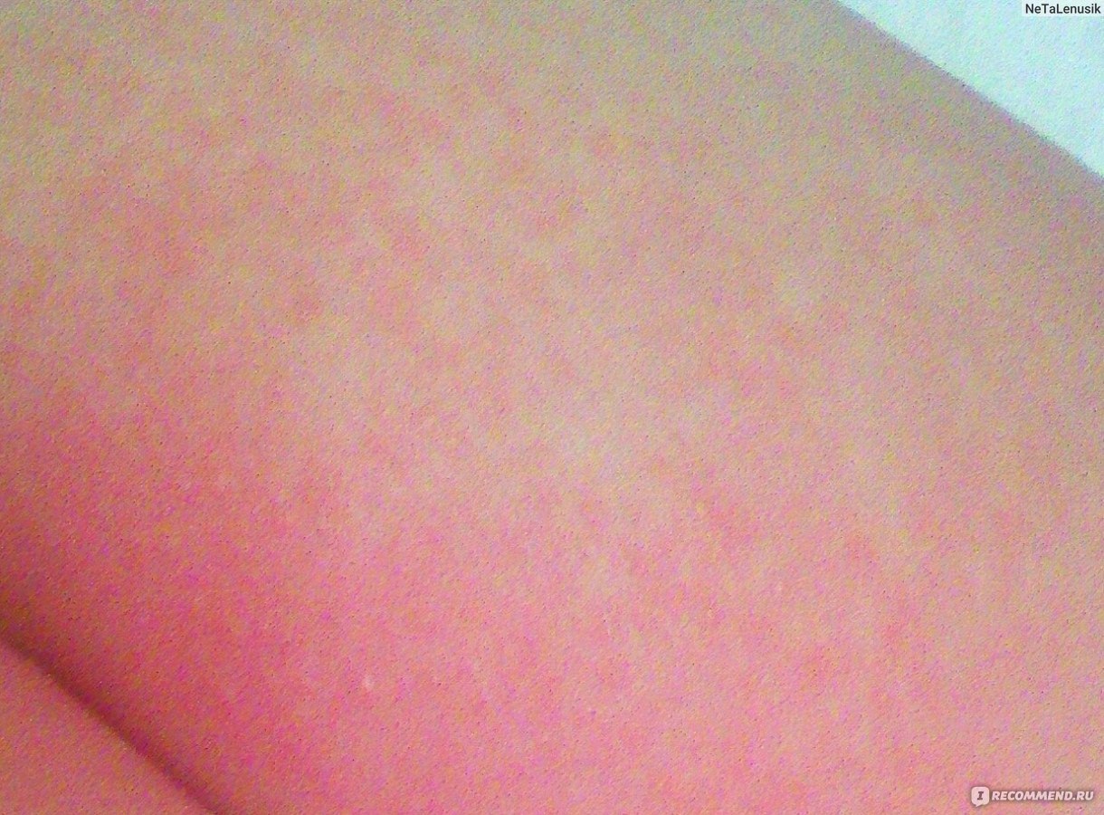 Аллергия на салфетки у детей