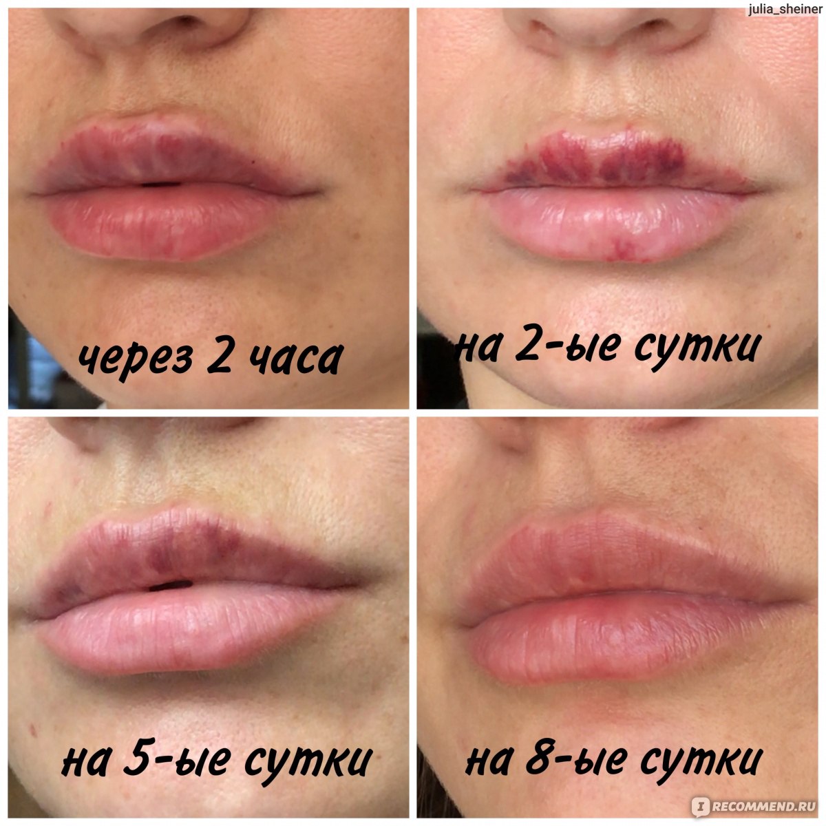 Гиалуроновые усы после увеличение губ